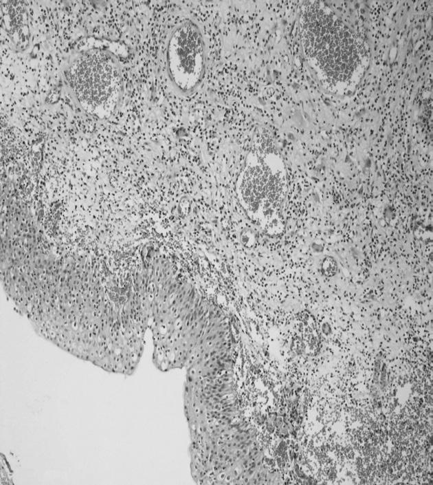 Ölçücüoğlu ve ark. Eozinofilik sistit: Olgu sunumu Resim 1 neği alınarak sitolojik inceleme için patolojiye gönderildi. Sitolojik incelemede malignite hücreleri izlenmediği rapor edildi.