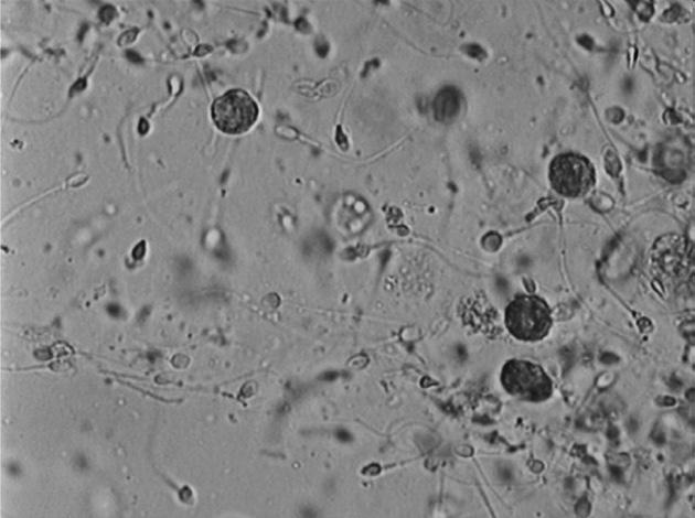 Koyun Asthenozoospermik olgulara laboratuvarın yaklaşımı Fig. 1. Leucocytes in semen. Semen sample stained with Leucoscreen (x 400) Fig. 2. Died sperms(pink).