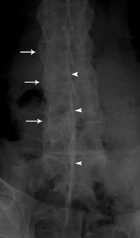 kesiminde irregülarite ve erezyon (beyaz ok) izleniyor. Ayrıca L3 vertebrada sindezmofit (siyah ok) görülüyor.