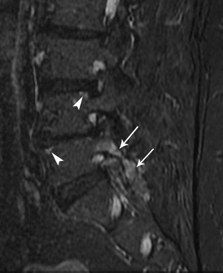 Ayrıca üst lumbal düzeylerde anterior vertebral köşelerde Tip II Romanus lezyonları izleniyor (ok başları).