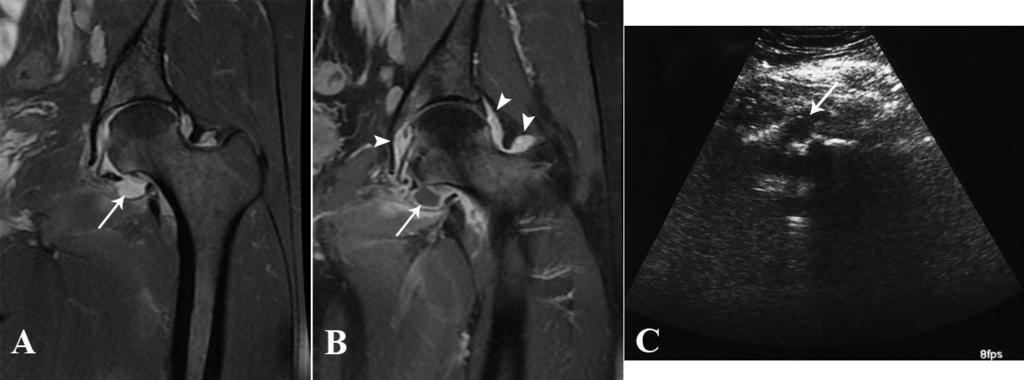 Şekil 11. Koronal yağ baskılı T2AG (A) ve ıvkm sonrası yağ baskılı T1AG de (B) sol kalça ekleminde efüzyon (ok) ve synovial inflamasyon (ok başları) izleniyor.