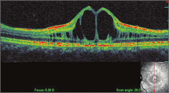 Ret-Vit 2012;20:Özel Sayı:21-27 Batıoğlu 23 Resim 2: Makülada kistoid ödem. Resim 3: Makülada ince septalarla birbirinden ayrılan büyük kistoid boşluklar.