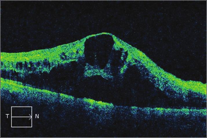 Sert eksudalar spektral OKT de yüksek yansıtıcılıklı retina içi birikintiler olarak izlenirler (Resim 6). Daha çok dış pleksiform tabakada bulunurlar.