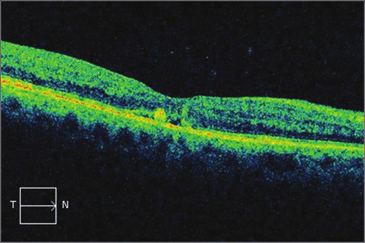 18 Bu noktalar biyomikroskopide veya fundus fotoğrafında izlenmez, sert eksudaların öncüsü olduğu düşünülmektedir. Kan-retina bariyeri bozukluğunun erken klinik bulgusudur.