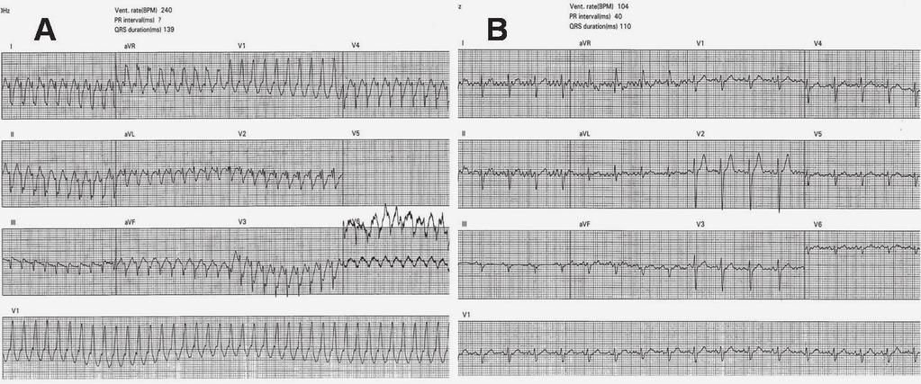 96 Türk Aritmi, Pacemaker ve Elektrofizyoloji Dergisi Olgu Sunumu Yirmi bir yaşında erkek bir hasta, 3 yıldır devam eden çarpıntı yakınması ile merkezimize başvurdu.