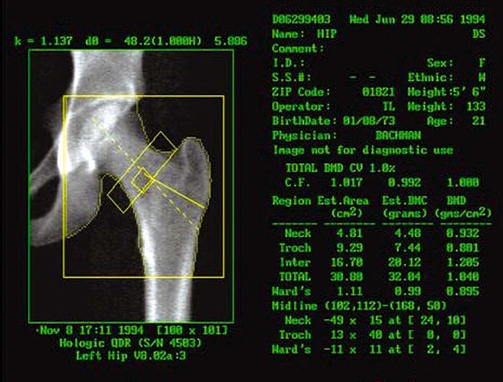 Proximal femur BMD