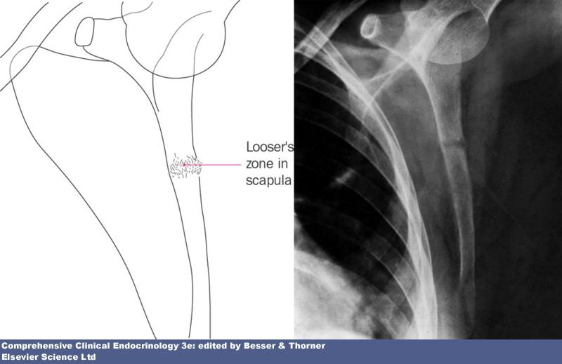 Osteomalacia: