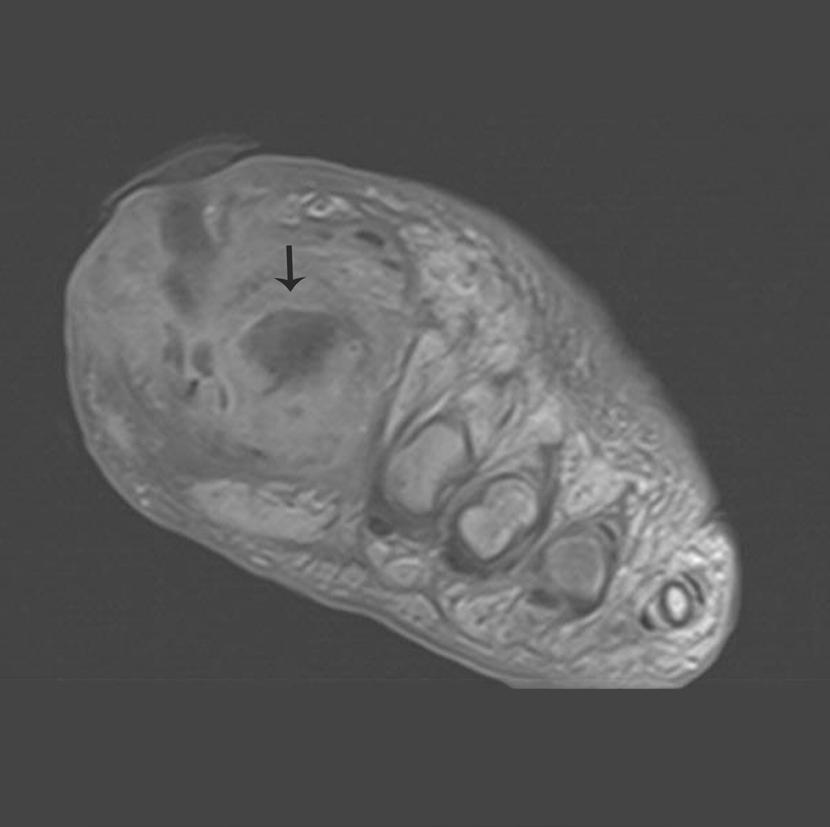512 Kerimoğlu Ü. eklem kenarlarında kemik proliferasyonu izlenebilir. Periosteal yeni kemik oluşumu metatarsal kemik ve falankslarda da izlenebilir.