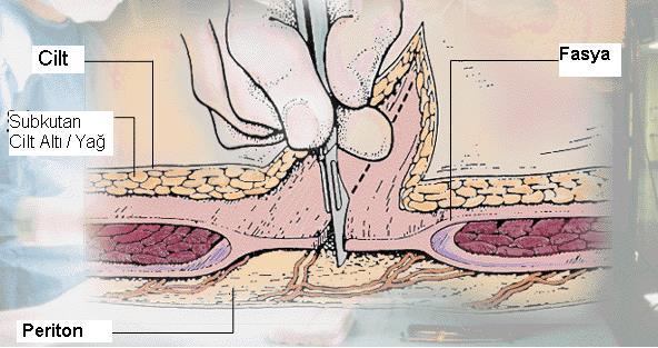 Kritik Yara İyileşme Periyodu Cilt Mukosa 5-7 gün 5-7 gün Subkutan Periton 7-14