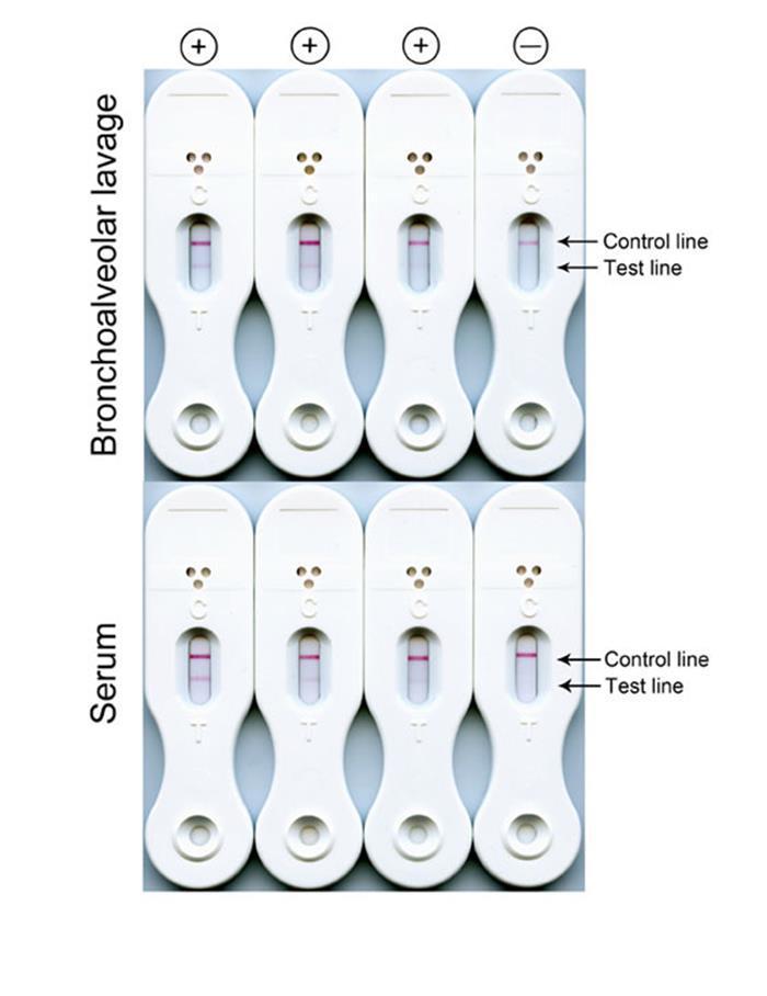 Aspergillus Lateral Flow Device (LFD)