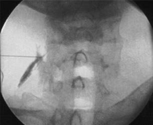 152 TOTBİD Dergisi (a) (b) Şekil 2. a, b. Servikal transforaminal steroid enjeksiyonu (a). Servikal interlaminer steriod enjeksiyonu (b).