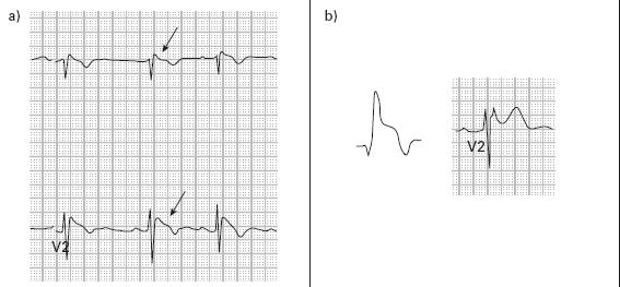 Genç, Senkop hasta Brugada Sendromu Brugada P, Brugada J. Right bundle branch block, persistent ST-segment elevation and sudden cardiac death: A distinct clinical and electrocardiographic syndrome.