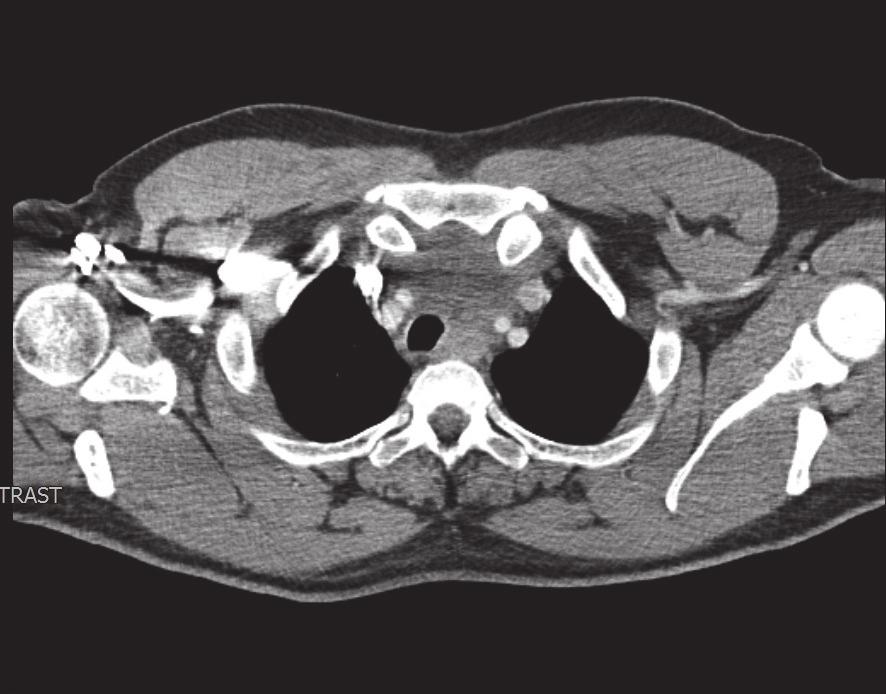 ENDOBRONŞİYAL ULTRASONOGRAFİ EŞLİĞİNDE YAPILAN TRANSBRONŞİAL kitleden TBNA yapıldı ve bu olguların hepsinde (%100) kitleden yapılan TBNA tanısal idi.