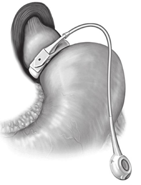 Distaldeki açık uç ile gastrik poş arasında anastomoz (gastrojejunostomi) yapılır. İnce barsağın mide ile anastomoz yapılan bu kısmına, Roux bacağı (alimentary ya da enterik bacak) denir.