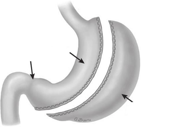 Biliyopankreatik bacak adını alan bu segment, gastrojejunostomi anastomozunun 75-150 cm distalindeki jejunuma bağlanarak, biliyopankreatik ve enterik bacaklar birleştirilir (Şekil 5.5.1).