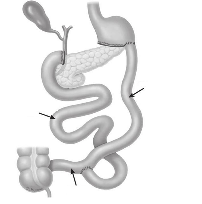 OBEZİTE TEDAVİSİ 55 kişilerde, gastrik bypass, biliyopankreatik diversiyon gibi daha zor ve kompleks ameliyatlar öncesi, fazla kiloları azaltmak için önerilen ilk basamak operasyon tipidir.