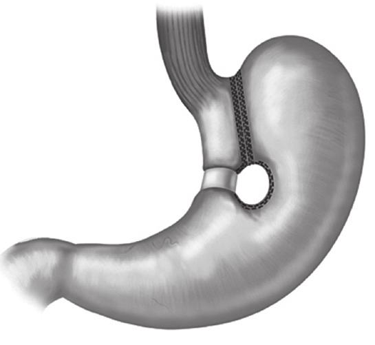 56 OBEZİTE TANI ve TEDAVİ KILAVUZU 2017 5.5.4. Restriktif ve malabsorptif işlemlerin karşlaştırması Kilo verdirmede gastrik bypass, gıda alımını kısıtlayan VBG ve AGB den daha üstündür.