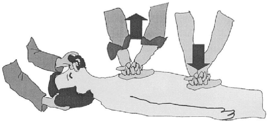 3 kifli ile uygulan r (Resim 6) (12), bir kifli gö üs kompresyonu ve bir kifli manuel olarak abdominal kompresyon yapar.