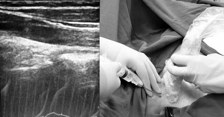 Turk Gogus Kalp Dama Şekil 1. Ultrasonografi eşliğinde kateter yerleştirme işlemi ve sağ juguler venin ultrasonografik görüntüsü.