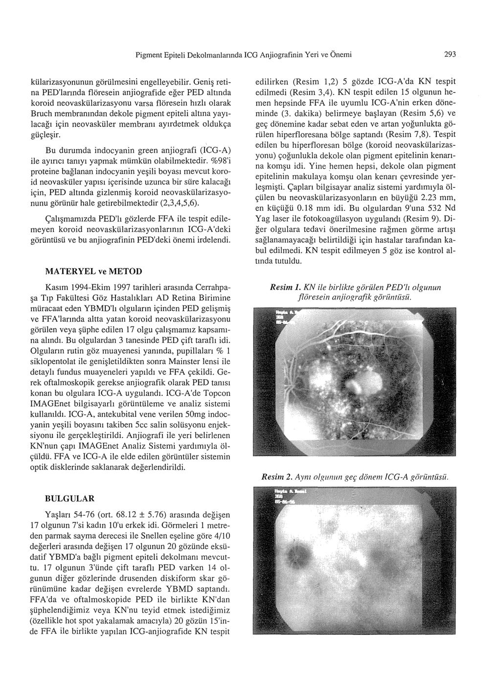 Pigment Epiteli Dekolmanlannda ICG Anjiografinin Yeri ve Onemi 293 kiilarizasyonunun goriilmesini engelleyebilir.