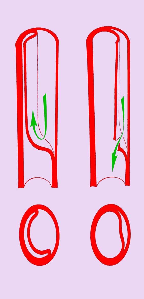 Patogenez İntimal Flap Re-entry