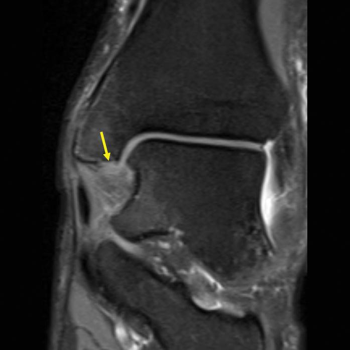 Ayak Bileği: Bağ ve Tendonlar 495 A Resim 5. A, B. Deltoid bağ yaralanması.