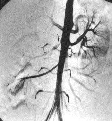 A B C D Resim 1. Olgu no 6. A. Abdominal aortografide sa renal arter ç k m nda %95 pretrombotik stenoz (ok) görülmektedir.