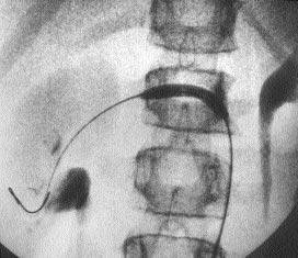 Tüm olgularda 4-5 Fr pigtail kateter ile diyagnostik abdominal aortografi yap ld.