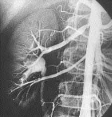 Diyagnostik kateterlerin içerisinden PTRA kateterlerini taş yabilecek k lavuz tel (Firm torquable guidewire, 0.035 inch x 180 cm, Flex Medics Corp., MN, USA) ilerletildi.