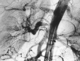 Abdominal aortan n en s k tutulan dallar renal arterler (%47), süperior mezenterik arter (%29) ve inferior mezenterik arterdir (%27) (10).