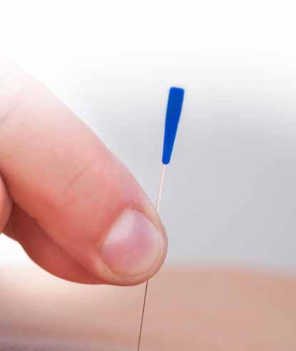 Gerilim (stres tipi) baş ağrısında akupunktur tedavisi; epizodik ve kronik gerilim tipi baş ağrılarında, faydalı bir non-farmakolojik (ilaç dışı) uygulama olarak kabul edilmiştir (2).