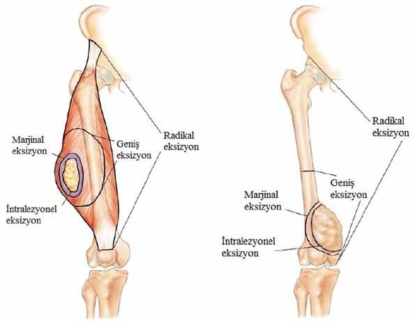 218 TOTBİD Dergisi Şekil. Yumuşak doku ve kemik tümörlerinde rezeksiyon tipleri [20] ve/veya fasya ile birlikte çıkarılır.