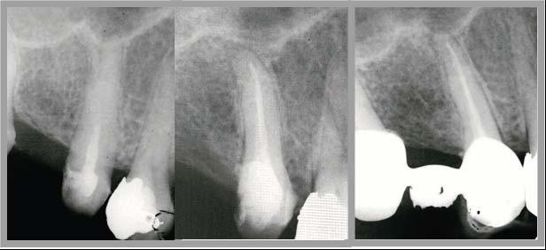 Şekil 5 a) 15 nolu dişin teşhis radyografisi b) Manuel yöntemleu zaklaştırmayı takiben yenilenen kök kanal dolgusu c) 3 ay sonra klinik ve radyografik başarı. 9.BULGULAR Tüm vakalarda 1., 3., 6., 12.