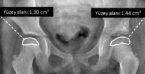 [2] Osteotomi, anterior inferior iliyak çıkıntının hemen üzerinden başlar ve posteriorda triradiat kıkırdağa doğru devam eder.