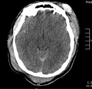 Kapalı kafa travması sonrası venöz sinüs trombozu Şekil 1. Kırık hattının ve yaygın serebral ödemin görüldüğü beyin BT görüntüleri.
