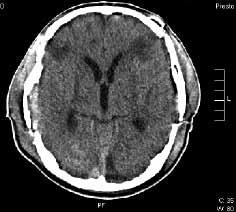Ameliyat sırasında bilateral beyin hemisferlerinin ileri derecede ödemli ve venöz konjesyone olduğu görüldü.