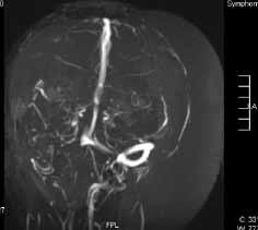 Ulus Travma Acil Cerrahi Derg Şekil 4. Sağ internal juguler venin tromboze olduğunu gösteren beyin MR-Venografi. rollu ventriküloperitoneal şant takıldı (Şekil 5).
