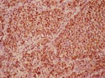 Tümör hücrelerinde diffüz pozitif boyanma. CD 45 * 400 (immun peroksidaz fiekil 3. Patoloji preperatlar.