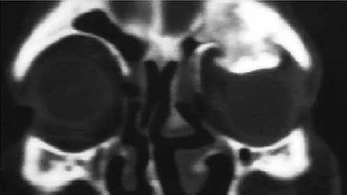 It was compatible with osteoma with its intense appearance (Figure 2). We consulted the patient with the Neurosurgery Department.