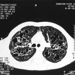 kilo kaybı, halsizlik) %15-30 Ekstrapulmoner bulgular %5-10 Hemoptizi %5 tanı oranı (%10-40) düşüktür. 72 Ayrıca pnömotoraks riski yüksektir.