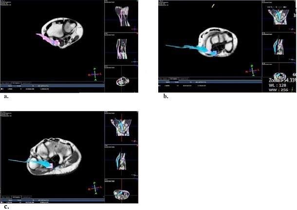 Şekil 3: FA renk kodlamalı harita ve T1A füzyon görüntüde DRUE (a.), psiform kemik (b.) ve hamate kemik (c.