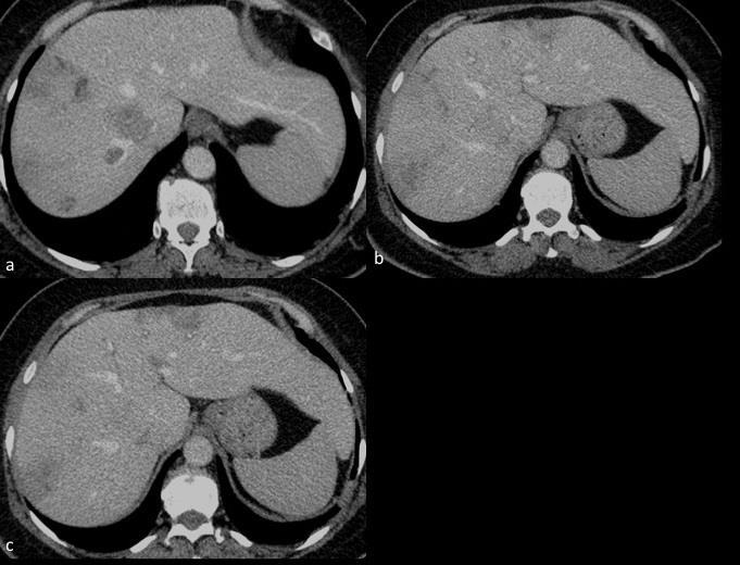 Resim Altyazıları Resim 1. Kontrastlı BT de karaciğerde birleşme eğilimi gösteren hipodens nodüler lezyonlar.