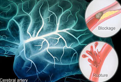 İNME Beyin kan damarlarının