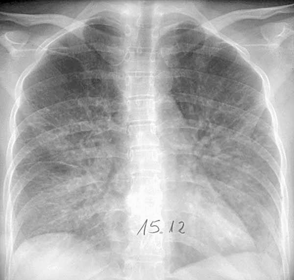 Pnömoni Radyolojik olarak direkt akciğer grafisinde pnömoni, bilateral