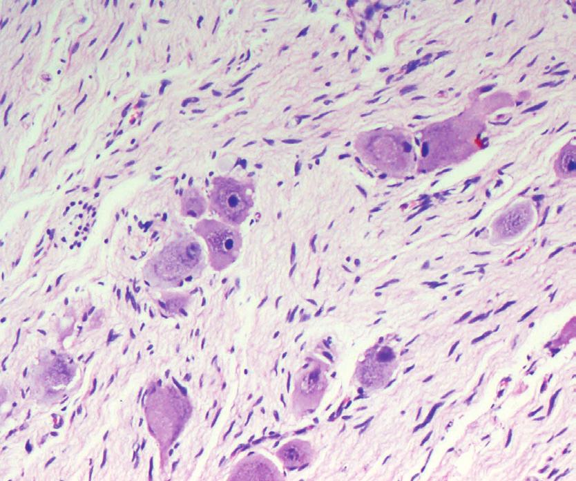 Boyanmasının Sağkalım ve Prognostik Faktörler ile İlişkisi Metaplastic Breast Carcinomas and Their Relationship with Basal-Like Phenotype Neoplastik ve Nonneoplastik Bronkopulmoner Lezyonların