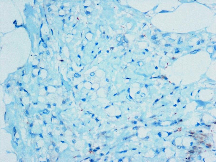 4.13. Taşlı Yüzük Hücre Diferansiasyonu Gösteren Karsinom (1 Vaka) Taşlı yüzük hücre diferansiasyonu gösteren karsinom hastasının yaşı 57 dir.