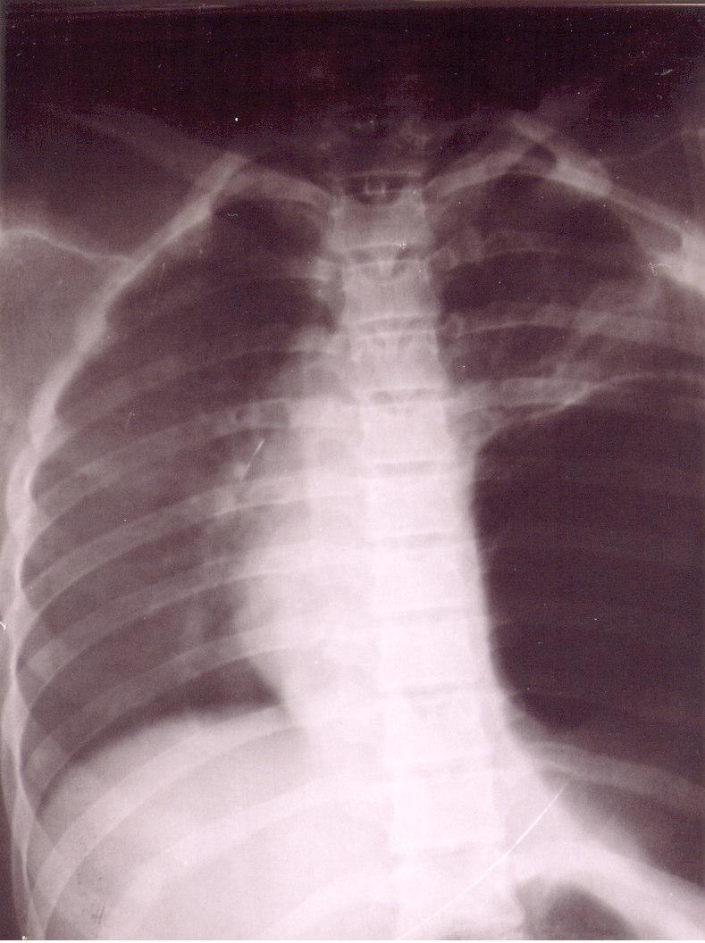 Resim 3 B: BT koronal MPR de Subdiafragmatik lipom Karında şişlik nedeniyle başvuran diğer hastanın yapılan AC grafilerinde sağda diyafragma hilus düzeyine kadar yükselmiş izlendi, yapılan USG de