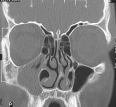 Paranazal sinüs anatomik varyasyonlar n n de erlendirilmesinde bilgisayarl tomografi ark. 9 taraf ndan %15.7 s kl kla, Zinreich ve ark. 13 taraf ndan %45.0 s kl kla ve Ünlü ve ark. 15 taraf ndan %61.