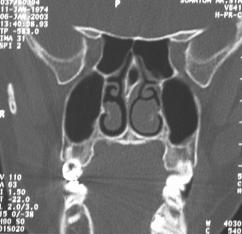 Paranazal sinüs anatomik varyasyonlar n n de erlendirilmesinde bilgisayarl tomografi Resim 10. Sfenoid sinüs ile devaml l k gösteren septum havalanmas.