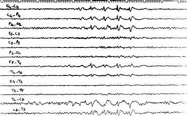 34 Epilepsi Cilt 12, Say 1, 2006 fiek L 1 Altm fl üç yafl nda erkek; multipl metabolik etken, sa frontotemporal alanda aktif epileptik aktivite bozuklu u.